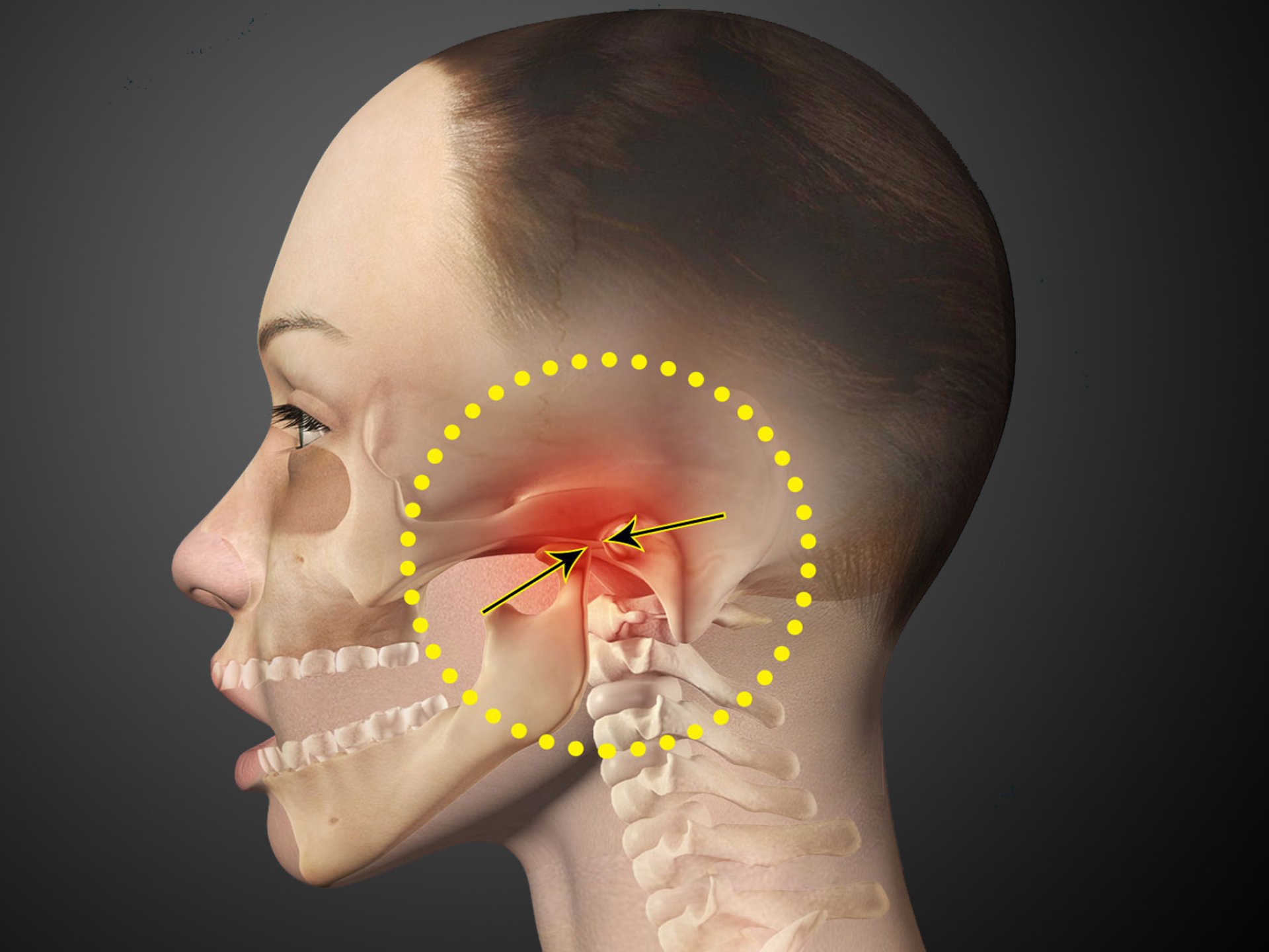 При открытии рта болит ухо. Артроз челюстно-лицевого сустава. Артроз височно челюстного сустава. Челюстью(дисфункция ВНЧС).